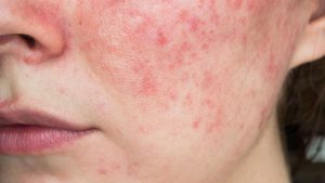 Rosacea Warriors: Creams That Tackle Redness Head-On