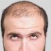 Is There a Cure for Permanent Baldness?