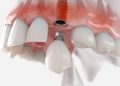 Restore Your Radiance: Dental Implants for Natural Beauty & Oral Health