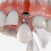 Restore Your Radiance: Dental Implants for Natural Beauty & Oral Health
