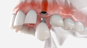 Restore Your Radiance: Dental Implants for Natural Beauty & Oral Health